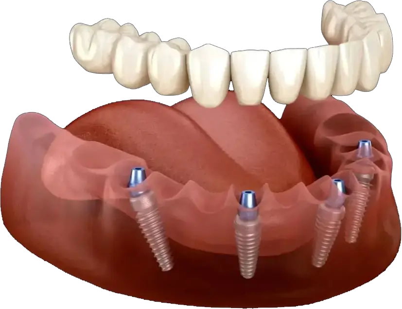 All-On-X Dental Implant
