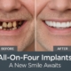A before-and-after image showcasing a patient's smile transformation with All-on-Four dental implants. The "before" side shows damaged or missing teeth, and the "after" side displays a full, natural-looking set of teeth. Text on image: "All-On-Four Implants: A New Smile Awaits".