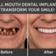 A before and after image showcasing a patient's smile transformation with full mouth dental implants. The "before" side shows missing and damaged teeth, while the "after" side displays a complete, natural-looking set of teeth. Text on the image says "Full Mouth Dental Implants: Transform Your Smile!"
