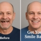 Before and after photo of a patient who received full mouth dental implants. The after photo has the text "Get Your Smile Back!" on the lower third.